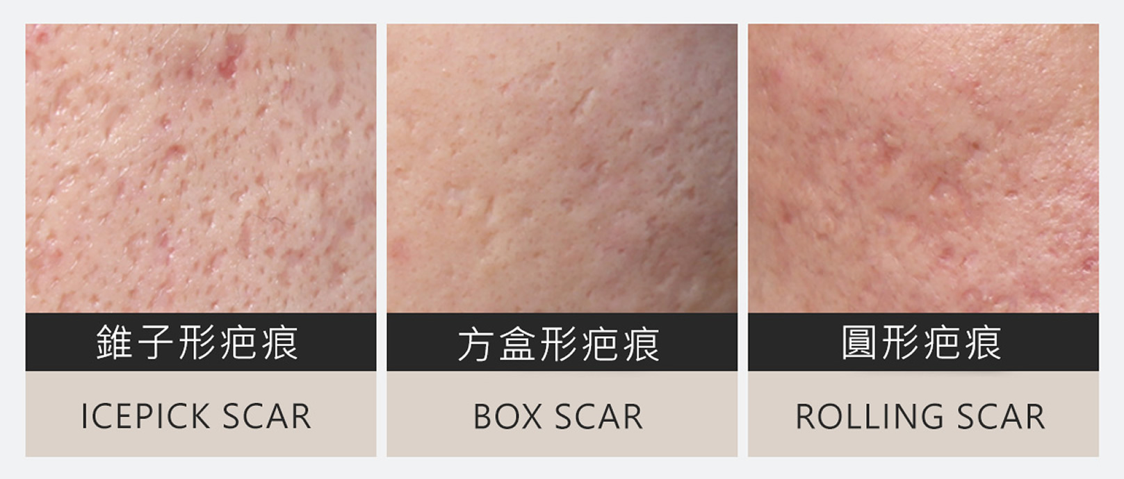 韓后醫美 韓國皮膚管理 凹洞類型：錐子形疤痕、方盒形疤痕、圓形疤痕。
