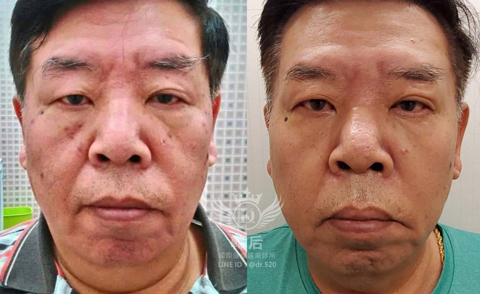 韓后醫美 韓國中胚層淡斑 素人真實案例