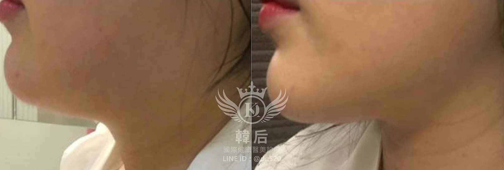 紅微波,雙下巴,下顎線,嘴邊肉,拉提效果,素人真實案例,韓后醫美