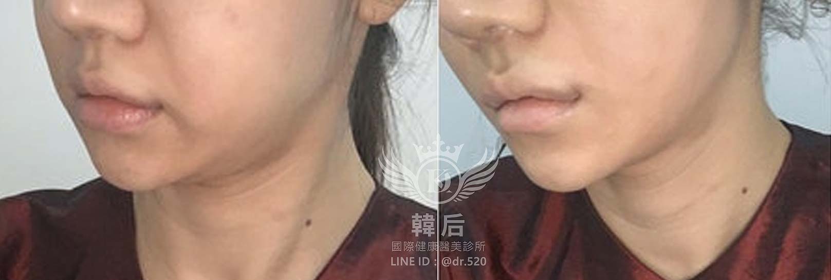 紅微波,雙下巴,下顎線,嘴邊肉,拉提效果,素人真實案例,韓后醫美