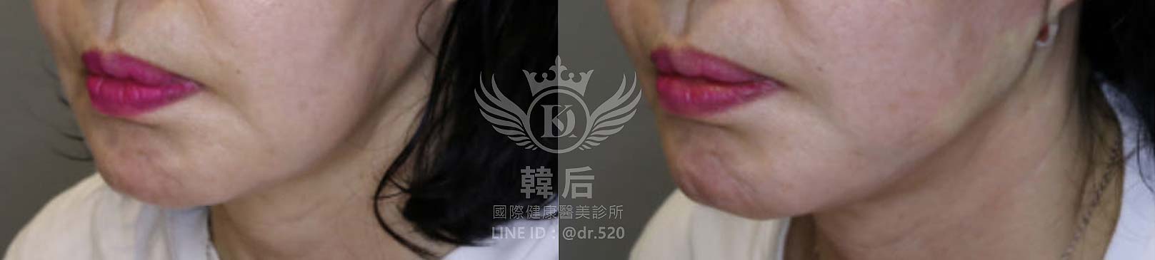 紅微波,雙下巴,下顎線,嘴邊肉,拉提效果,素人真實案例,韓后醫美