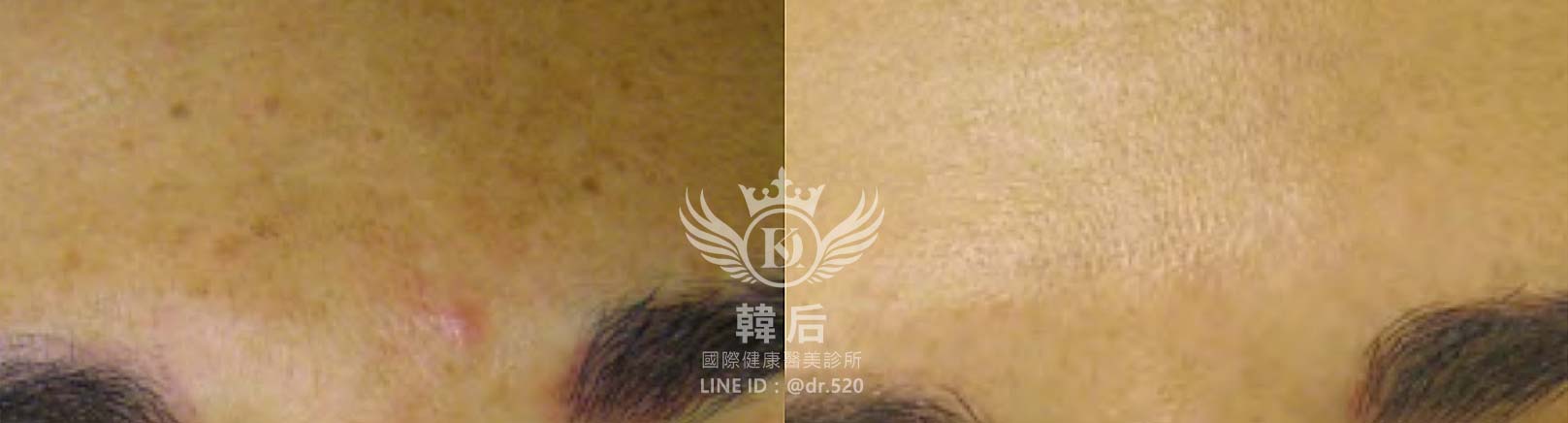 水飛梭,深層清潔,清除粉刺,高效保濕,補水鎖水,均勻膚色,預防痘痘,修護肌膚,改善粗糙,延緩老化,素人真實案例,韓后醫美