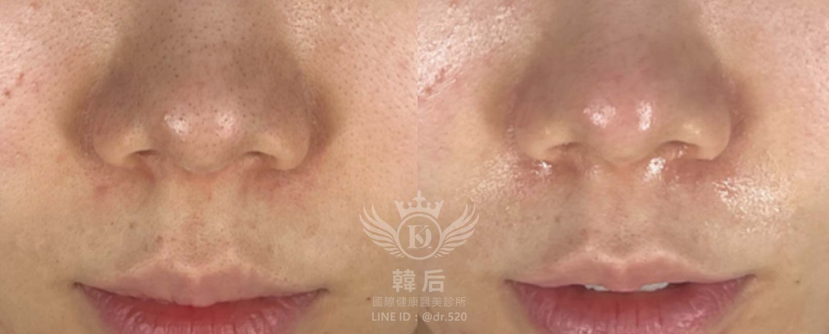 水飛梭,深層清潔,清除粉刺,高效保濕,補水鎖水,均勻膚色,預防痘痘,修護肌膚,改善粗糙,延緩老化,素人真實案例,韓后醫美