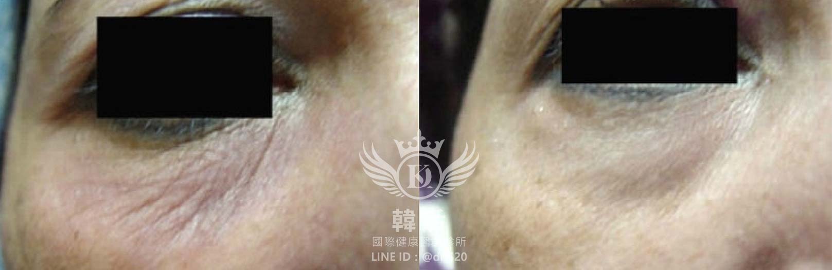 奈米晶片水光深導,促進膠原蛋白增生,淡化細紋,高效保濕,補水鎖水,均勻膚色,預防痘痘,除斑,修護肌膚,改善粗糙,延緩老化,素人真實案例,韓后醫美