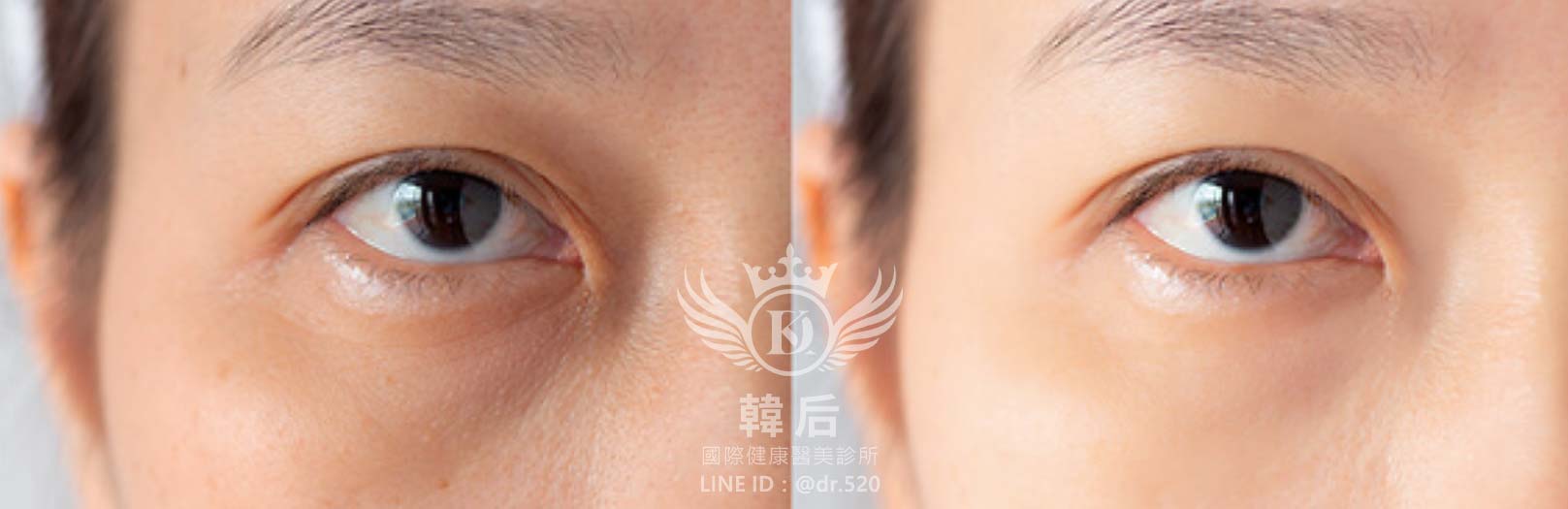 奈米晶片水光深導,促進膠原蛋白增生,淡化細紋,高效保濕,補水鎖水,均勻膚色,預防痘痘,除斑,修護肌膚,改善粗糙,延緩老化,素人真實案例,韓后醫美