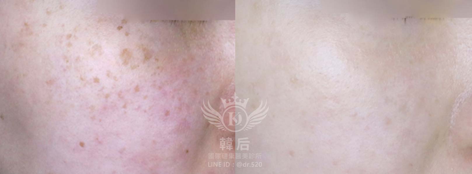 韓后醫美,韓國中胚層淡斑,素人真實案例