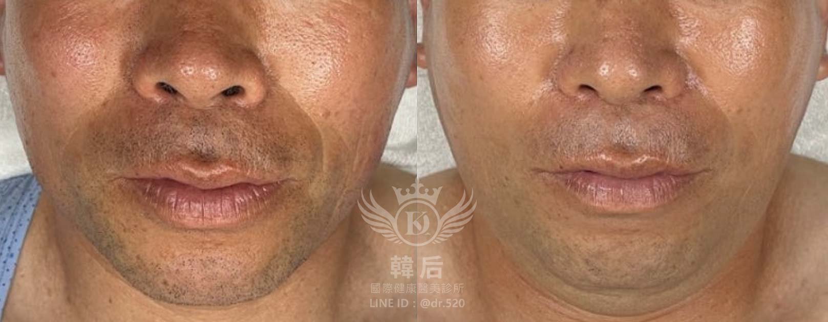 奈米晶片水光深導,促進膠原蛋白增生,淡化細紋,高效保濕,補水鎖水,均勻膚色,預防痘痘,除斑,修護肌膚,改善粗糙,延緩老化,素人真實案例,韓后醫美