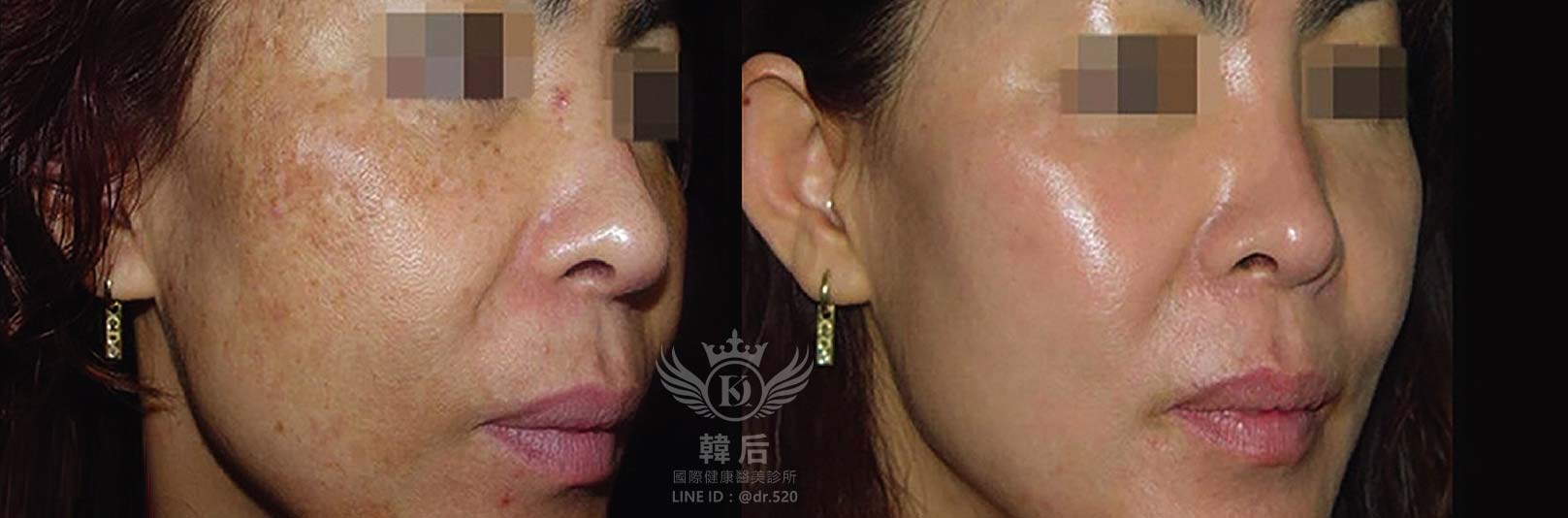 奈米晶片水光深導,促進膠原蛋白增生,淡化細紋,高效保濕,補水鎖水,均勻膚色,預防痘痘,除斑,修護肌膚,改善粗糙,延緩老化,素人真實案例,韓后醫美