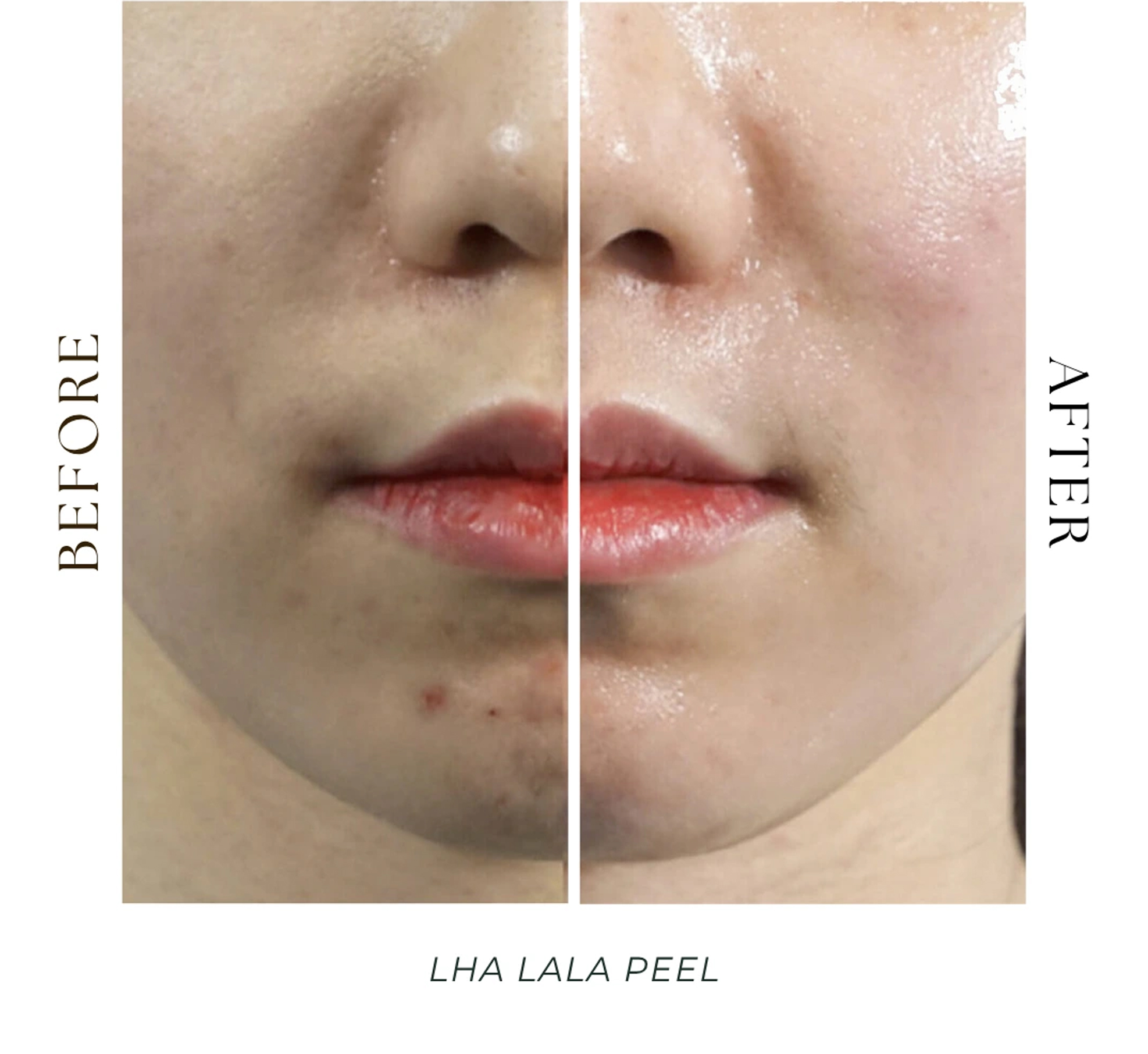 刷亮療程 LaLa Peel 鏡膜玻光肌 視覺示意對照 療程前後 水光膚感改善 海外原廠 韓后醫美