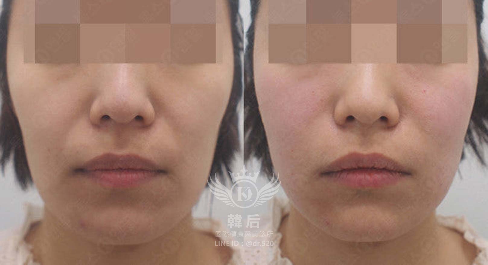 猛健樂臉,瘦瘦針臉,素人真實案例,膠原蛋白填充,玻尿酸填充,電波拉提,音波拉提,韓后醫美