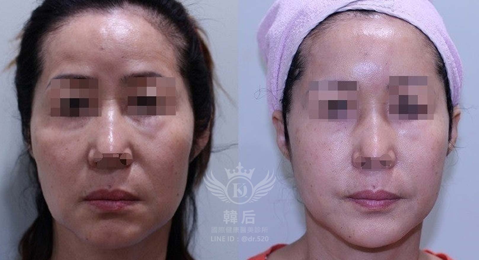 猛健樂臉,瘦瘦針臉,素人真實案例,膠原蛋白填充,玻尿酸填充,電波拉提,音波拉提,韓后醫美