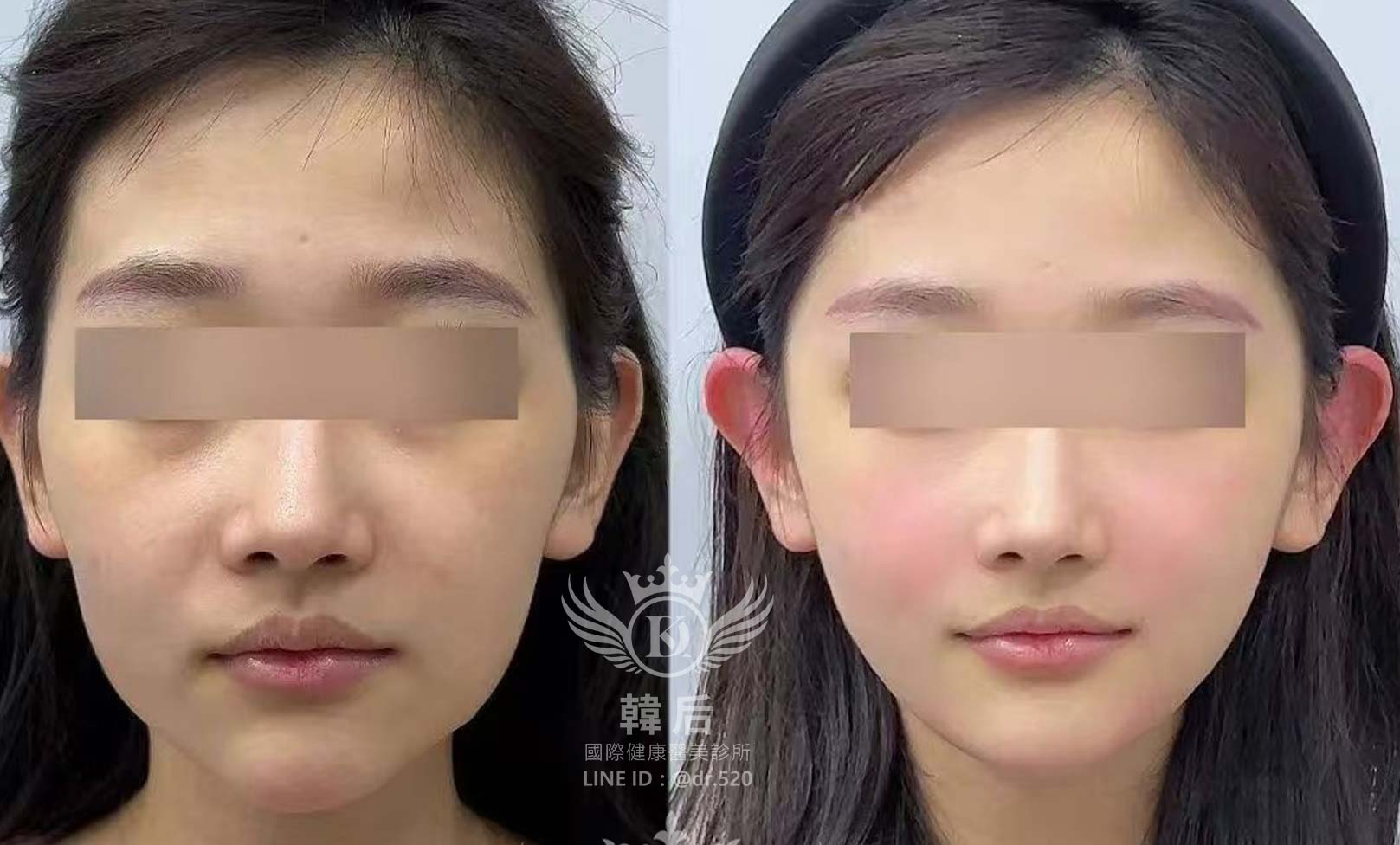 猛健樂臉,瘦瘦針臉,素人真實案例,膠原蛋白填充,玻尿酸填充,電波拉提,音波拉提,韓后醫美