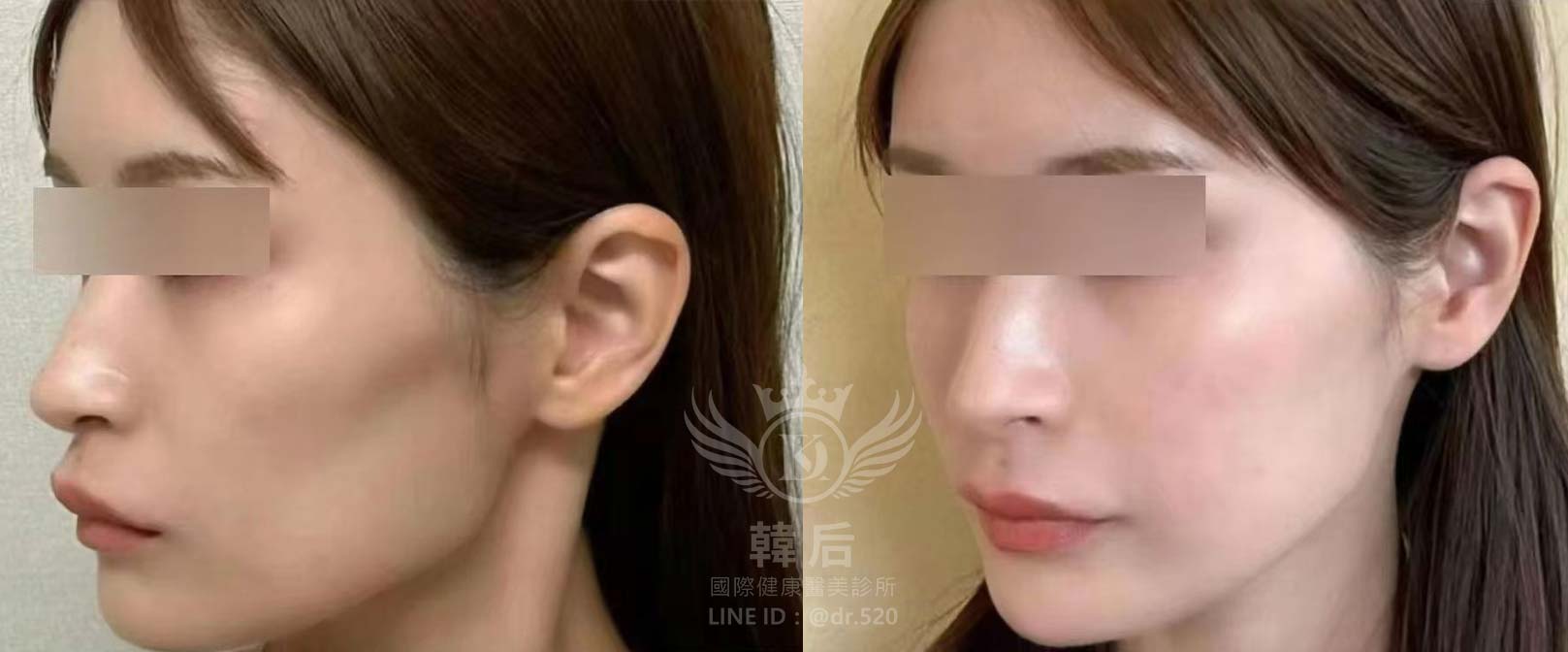 猛健樂臉,瘦瘦針臉,素人真實案例,膠原蛋白填充,玻尿酸填充,電波拉提,音波拉提,韓后醫美