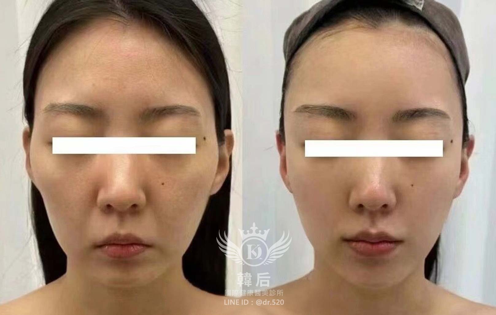 猛健樂臉,瘦瘦針臉,素人真實案例,膠原蛋白填充,玻尿酸填充,電波拉提,音波拉提,韓后醫美