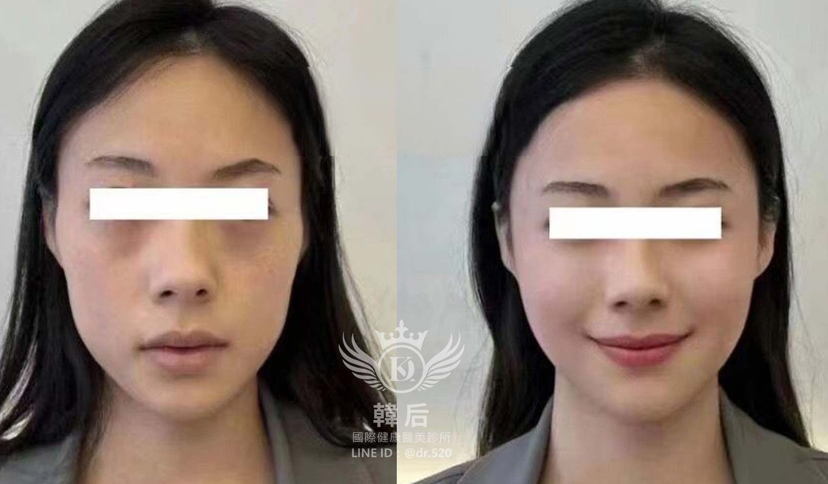 猛健樂臉,瘦瘦針臉,素人真實案例,膠原蛋白填充,玻尿酸填充,電波拉提,音波拉提,韓后醫美
