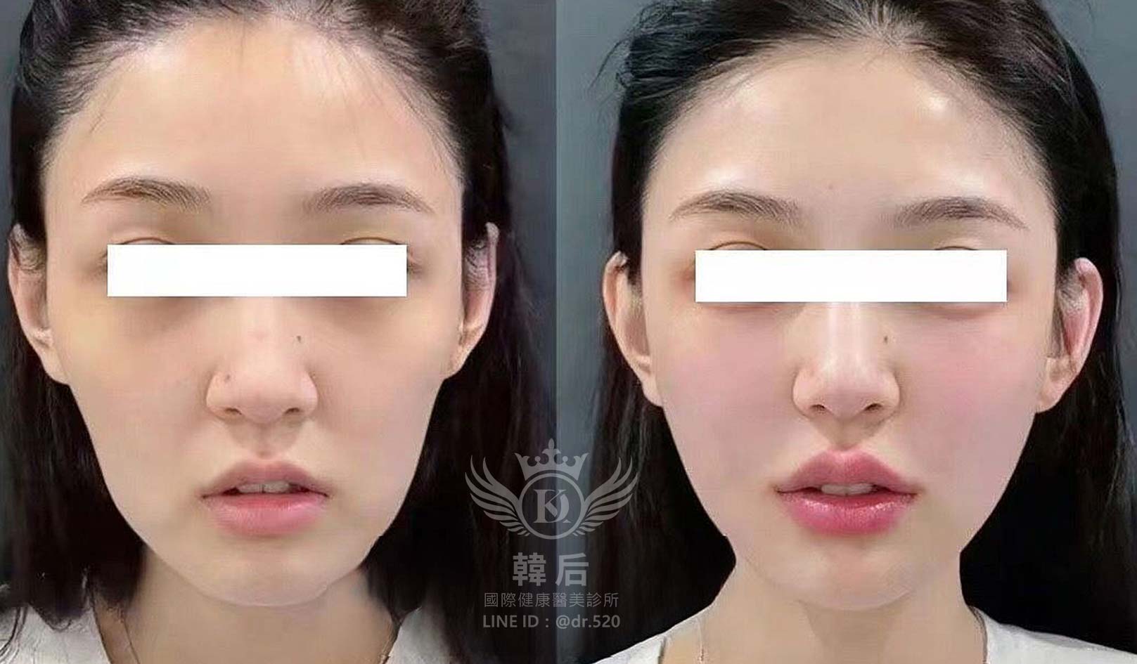 猛健樂臉,瘦瘦針臉,素人真實案例,膠原蛋白填充,玻尿酸填充,電波拉提,音波拉提,韓后醫美