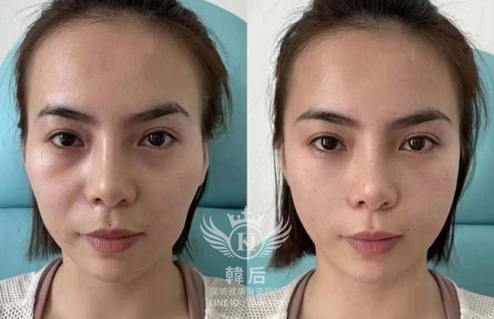 猛健樂臉,瘦瘦針臉,素人真實案例,膠原蛋白填充,玻尿酸填充,電波拉提,音波拉提,韓后醫美