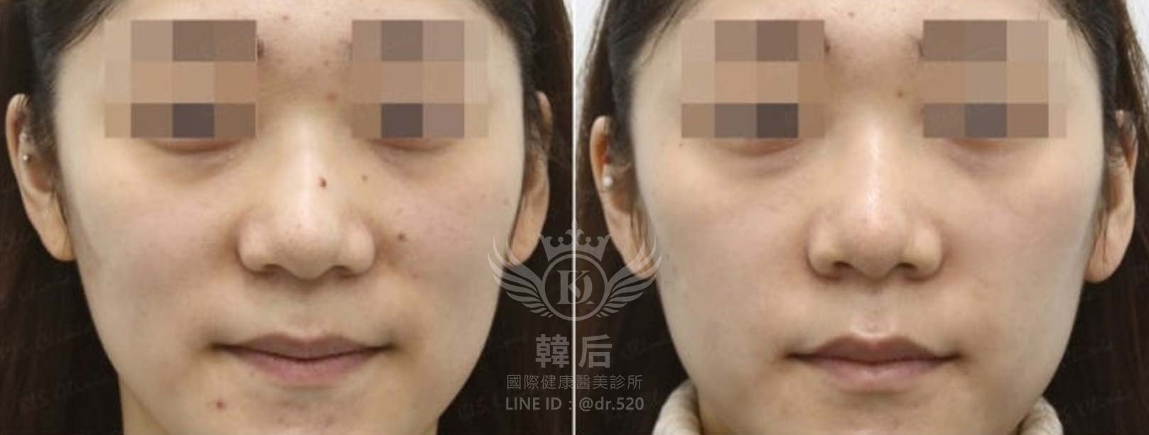 猛健樂臉,瘦瘦針臉,素人真實案例,膠原蛋白填充,玻尿酸填充,電波拉提,音波拉提,韓后醫美