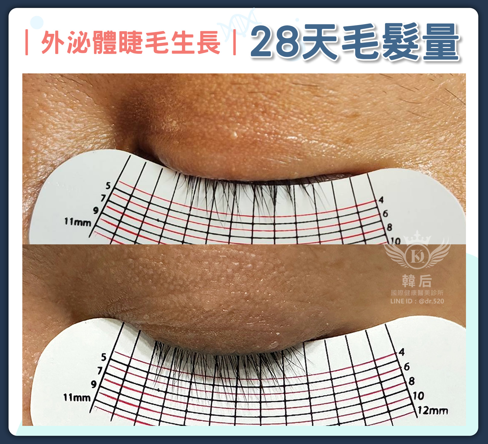 韓后醫美 Exosomes 韓國外泌體 睫毛增長 真實案例 使用28天明顯增長 濃密