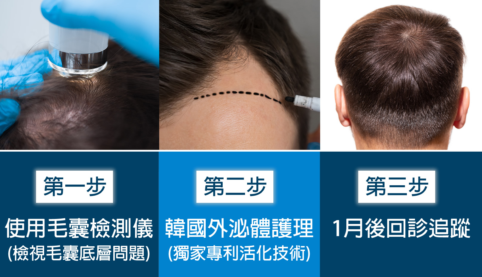 韓后醫美 Exosomes 韓國外泌體 健髮流程：第一步 使用毛囊檢測儀(檢視毛囊底層問題) > 第二步 韓國外泌體護理 > 第三步 1月後追蹤