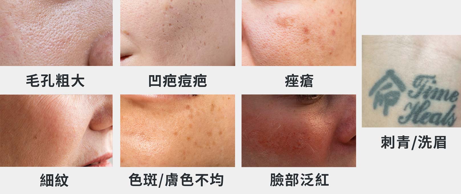 PICO Q美國黃金蜂巢皮秒雷射可改善6大肌膚問題：毛孔粗大、凹疤痘疤、痤瘡、細紋、色斑/皮膚不均、臉部泛紅、刺青/洗眉。韓后醫美