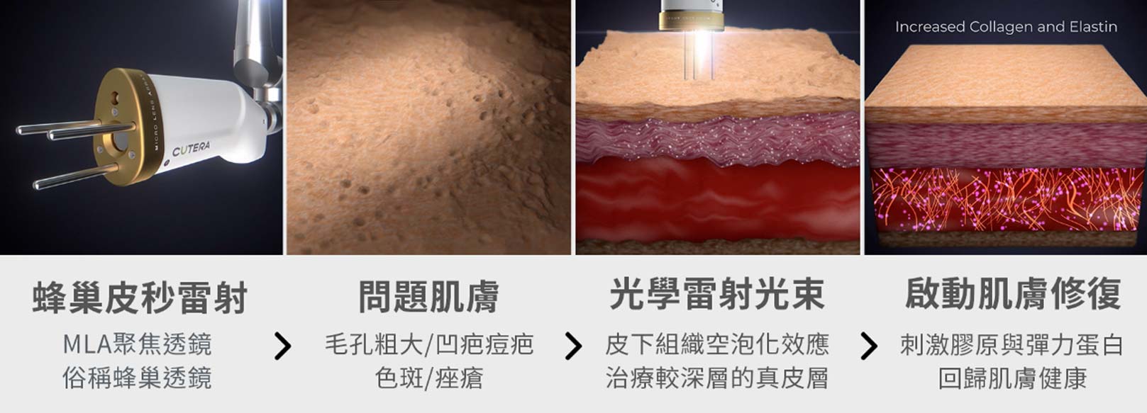 PICO Q美國黃金蜂巢皮秒雷射：MLA聚焦透鏡，俗稱蜂巢透鏡。問題肌膚：毛孔粗大/凹疤痘疤。色斑/痤瘡。光學雷射光束：皮下組織空泡化效應，治療較深層的真皮層。啟動肌膚修復：刺激膠原與彈力蛋白回歸肌膚健康。韓后醫美