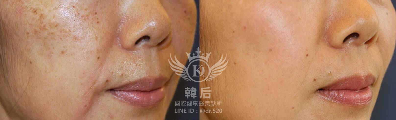 韓后醫美,PICO Q黃金蜂巢皮秒,素人真實案例