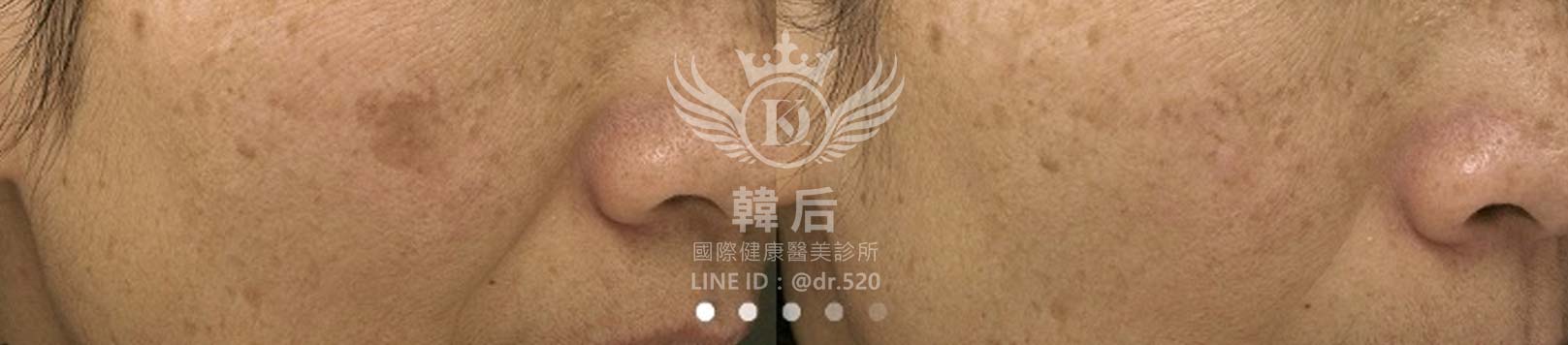 韓后醫美,PICO Q黃金蜂巢皮秒,素人真實案例
