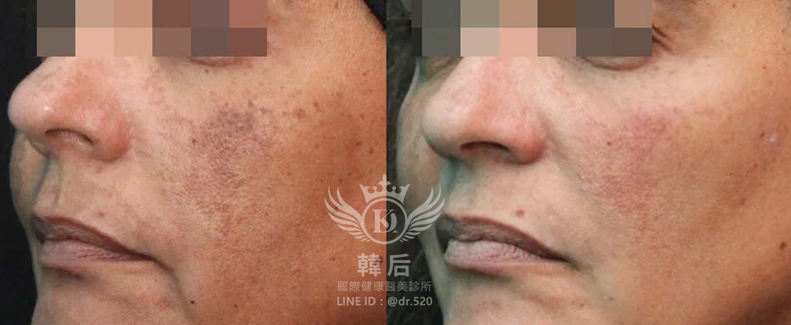 韓后醫美,PICO Q黃金蜂巢皮秒,素人真實案例