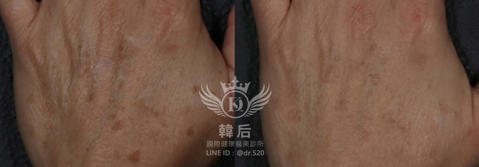 韓后醫美,PICO Q黃金蜂巢皮秒,素人真實案例