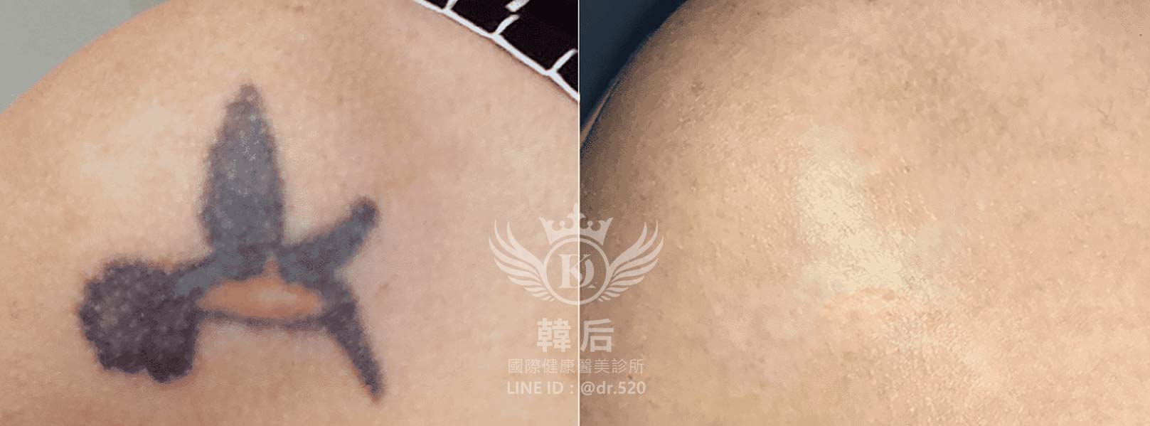 韓后醫美,PICO Q黃金蜂巢皮秒,素人真實案例