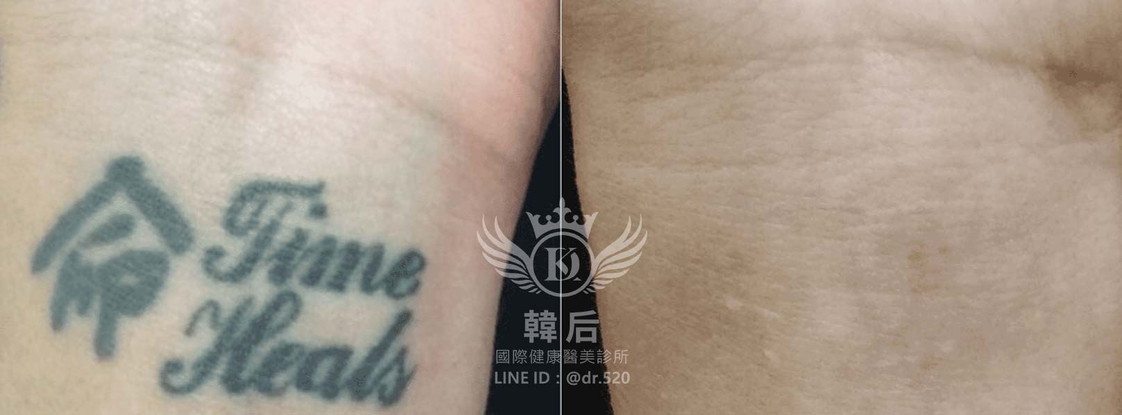 韓后醫美,PICO Q黃金蜂巢皮秒,素人真實案例