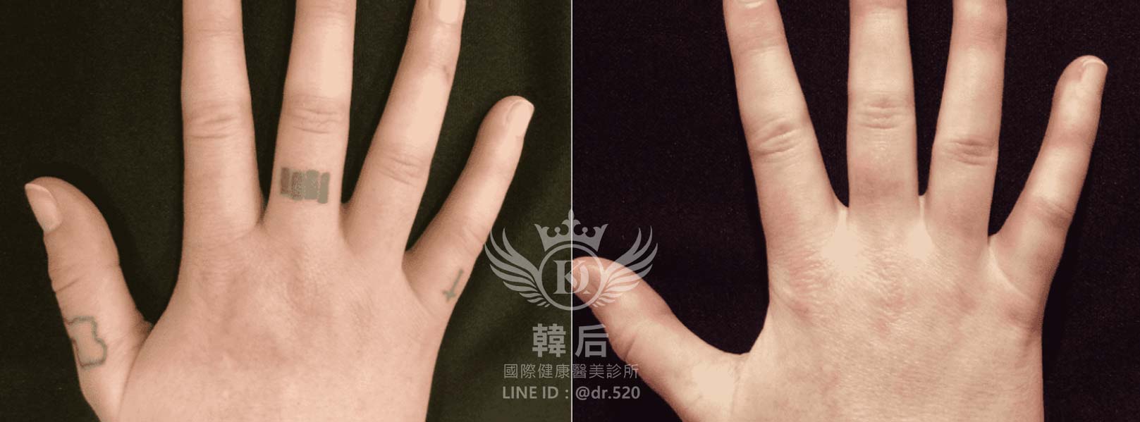 韓后醫美,PICO Q黃金蜂巢皮秒,素人真實案例
