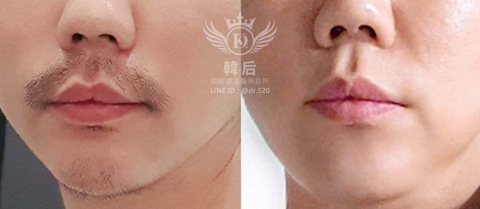 韓后醫美,LightSheer真空除毛,素人真實案例