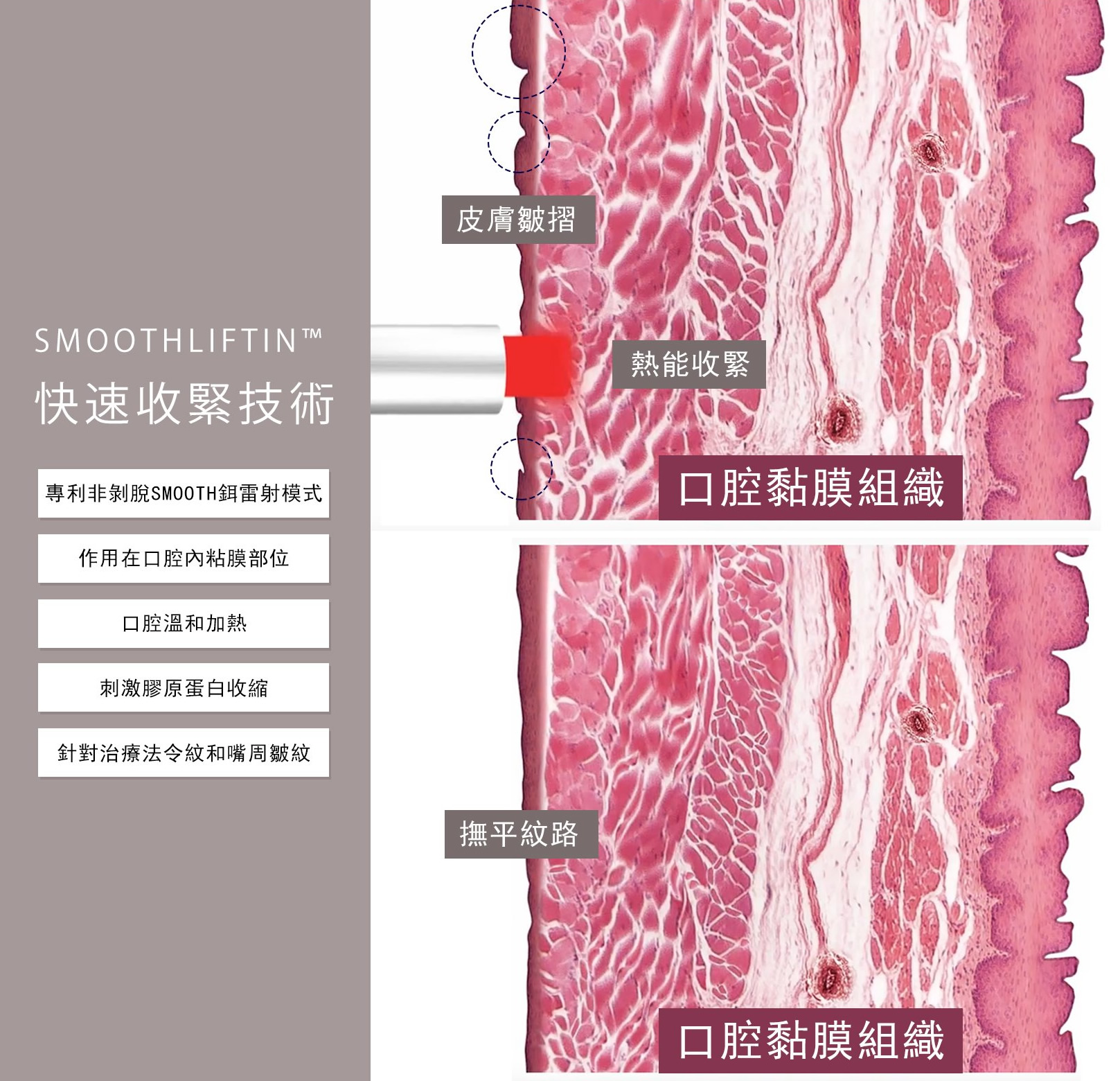 韓后醫美 4D口內拉提 Fotona 4D