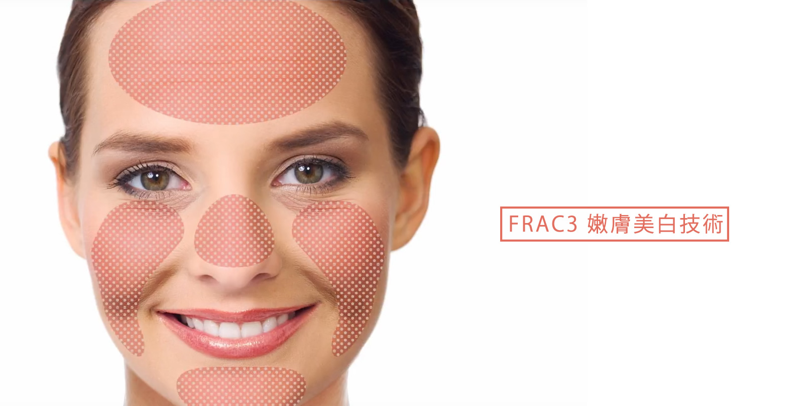 韓后醫美 4D口內拉提 FRAC3 嫩膚美白技術。