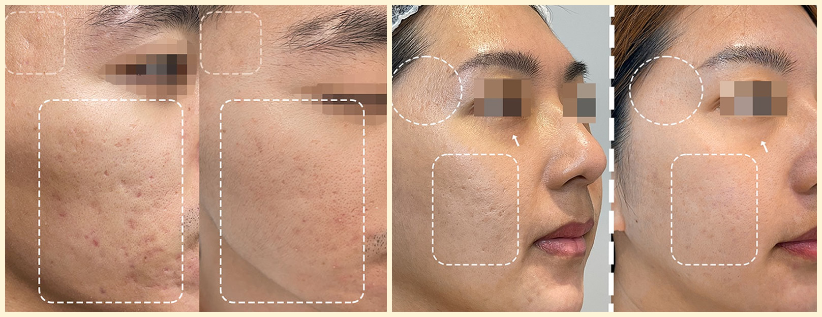 韓后醫美 提可塑 Tixel 臉部 痘痘 痘疤 毛孔粗大 素人真實案例