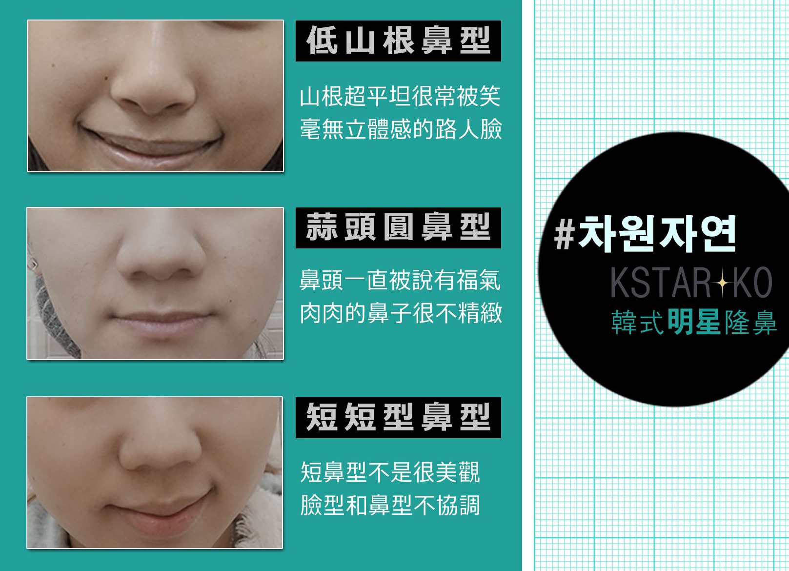 韓后醫美 K-STAR KO 韓式鼻雕：改造 低山根鼻型、蒜頭圓鼻型、短短型鼻型。