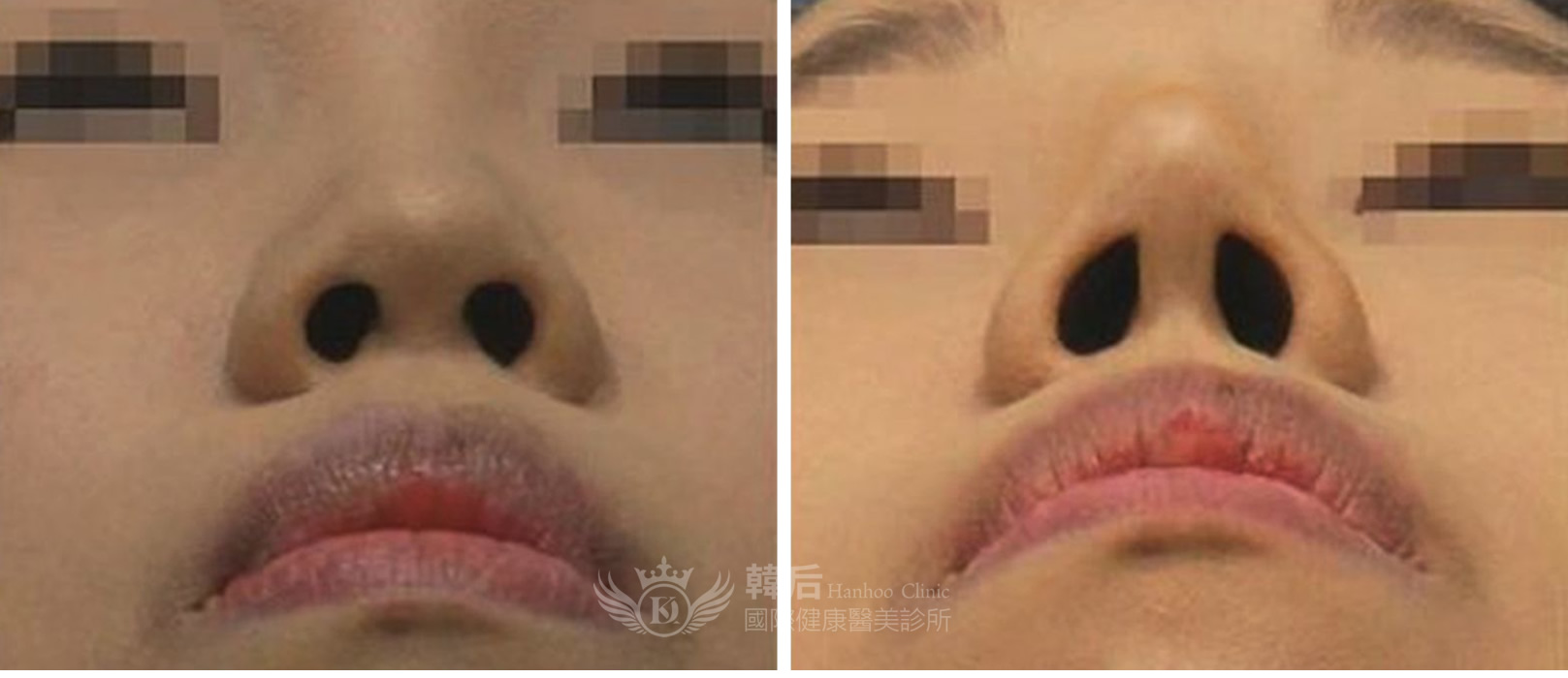 韓后醫美 K-STAR KO 韓式鼻雕 素人真實案例