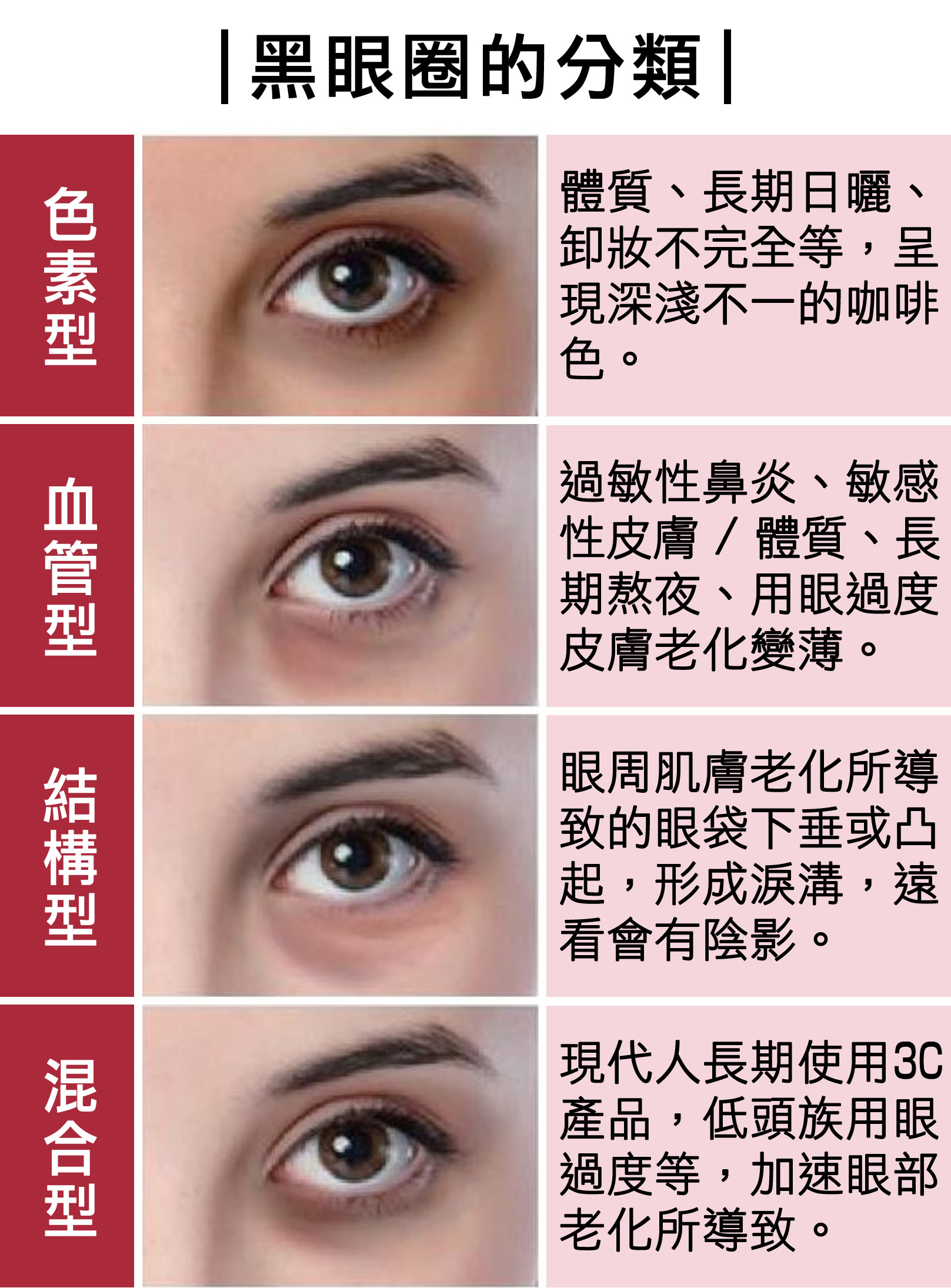 韓后醫美 膠原蛋白熊貓針 黑眼圈分類：色素型、血管型、結構型、混合型。