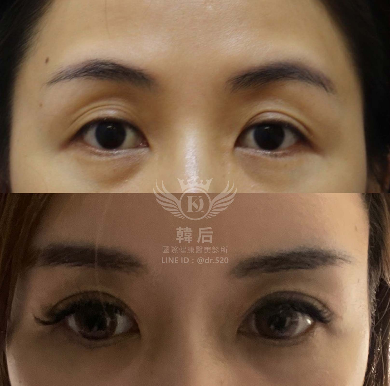 韓后醫美 免手術除眼窩凹陷 真實見證