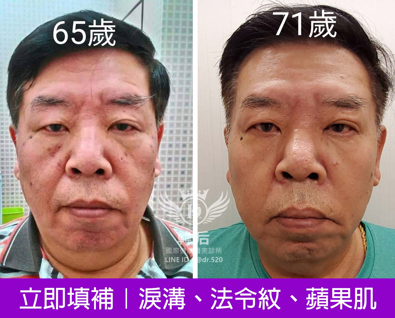 韓后醫美,Ellanse,洢蓮絲,填補,淚溝,法令紋,蘋果肌,素人真實案例