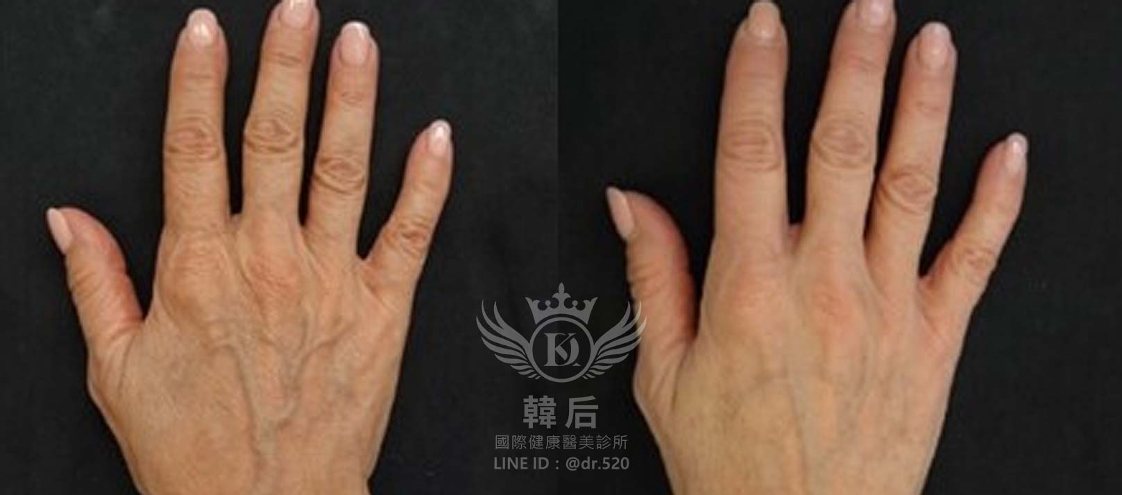 Profhilo逆時針,身體其他部位：手臂手掌出現的皮膚鬆弛,韓后醫美,改造前後,素人真實案例