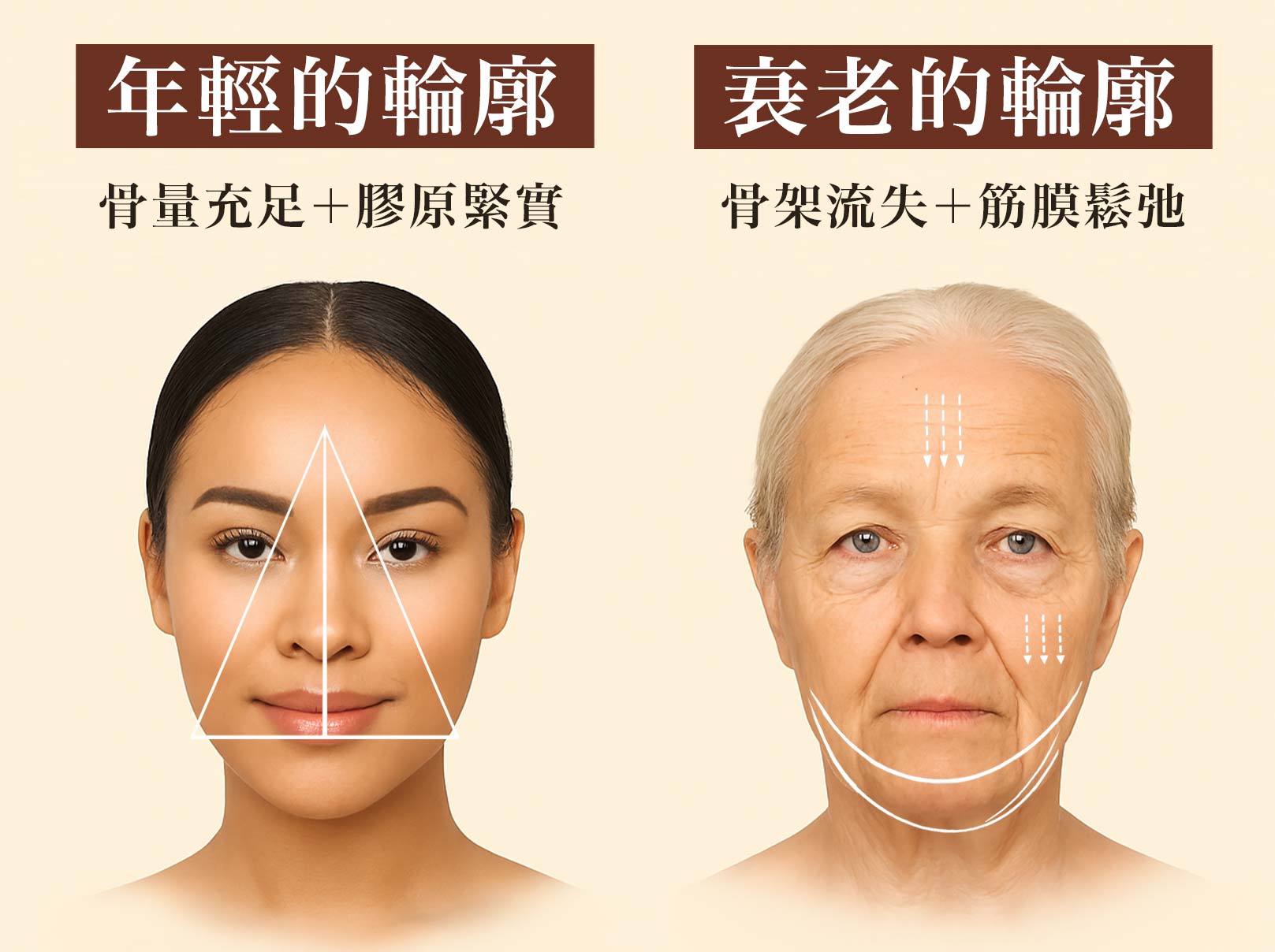 輪廓固定術,年輕輪廓：骨量充足＋膠原緊實＝穩定支撐力，維持臉部立體與緊緻。衰老輪廓：骨架萎縮＋筋膜鬆弛＝支撐力下降，導致凹陷與下垂。韓后醫美