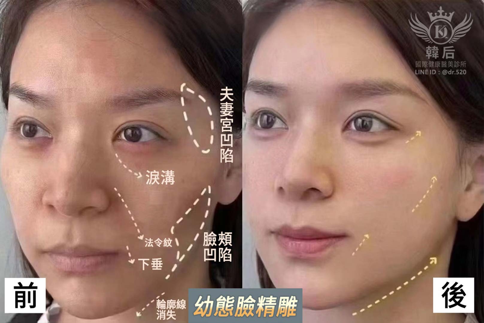 輪廓固定,幼態臉,全臉精雕,唇周,眼袋,淚溝,凹陷,蘋果肌,夫妻宮,木偶紋,皺紋,韓后醫美,改造前後,素人真實案例