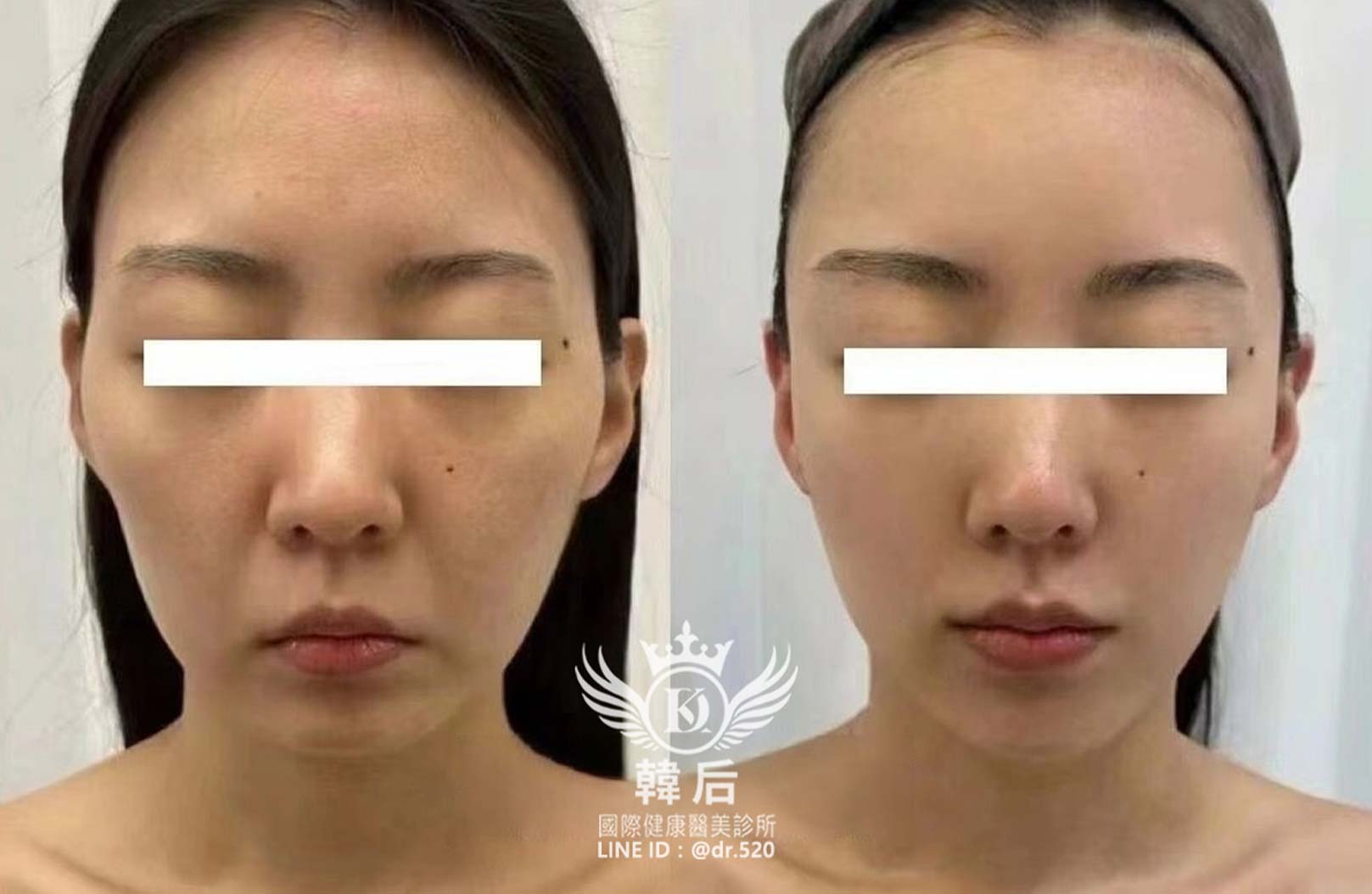 輪廓固定,幼態臉,全臉精雕,唇周,眼袋,淚溝,凹陷,蘋果肌,夫妻宮,木偶紋,皺紋,韓后醫美,改造前後,素人真實案例