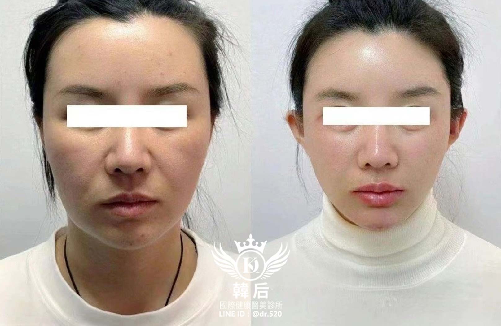 輪廓固定,幼態臉,全臉精雕,唇周,眼袋,淚溝,凹陷,蘋果肌,夫妻宮,木偶紋,皺紋,韓后醫美,改造前後,素人真實案例