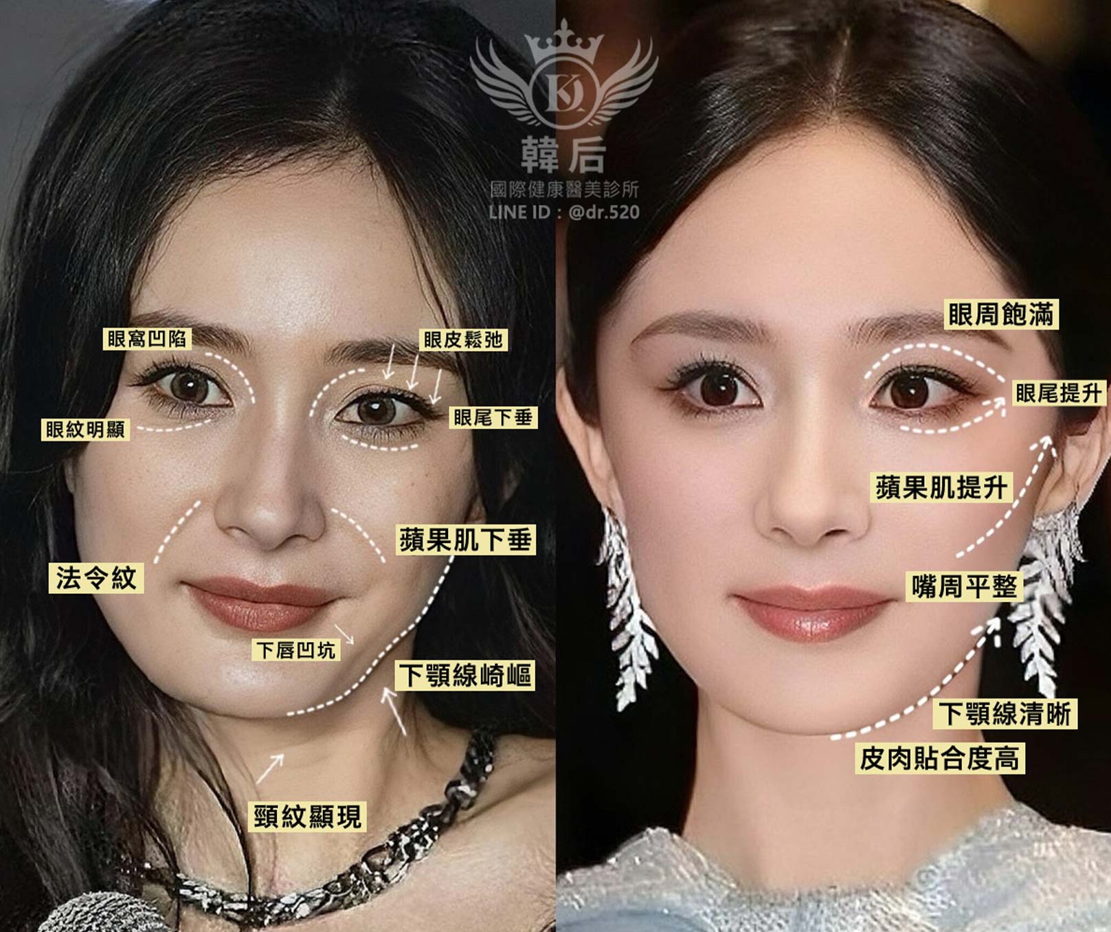 輪廓固定術,老化的輪廓線：眼窩凹陷,眼皮鬆弛,眼尾下垂,眼紋明顯,蘋果肌下垂,法令紋,下唇凹坑,下顎線崎嶇,頸紋顯現。輪廓固定術幼態臉調整後：眼周飽滿,眼尾提升,蘋果肌提升,嘴周平整,下顎線清晰,皮肉貼合度高。
韓后醫美