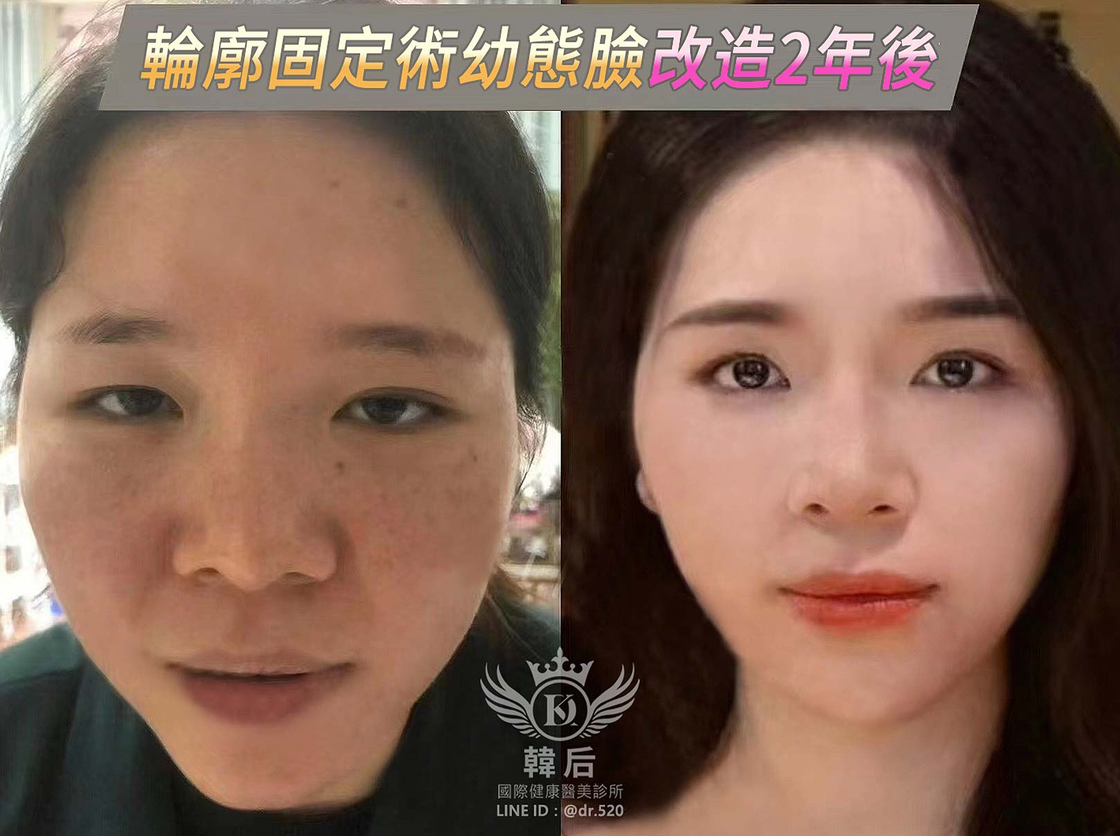 輪廓固定,幼態臉,全臉精雕,唇周,眼袋,淚溝,凹陷,蘋果肌,夫妻宮,木偶紋,皺紋,韓后醫美,改造前後,素人真實案例