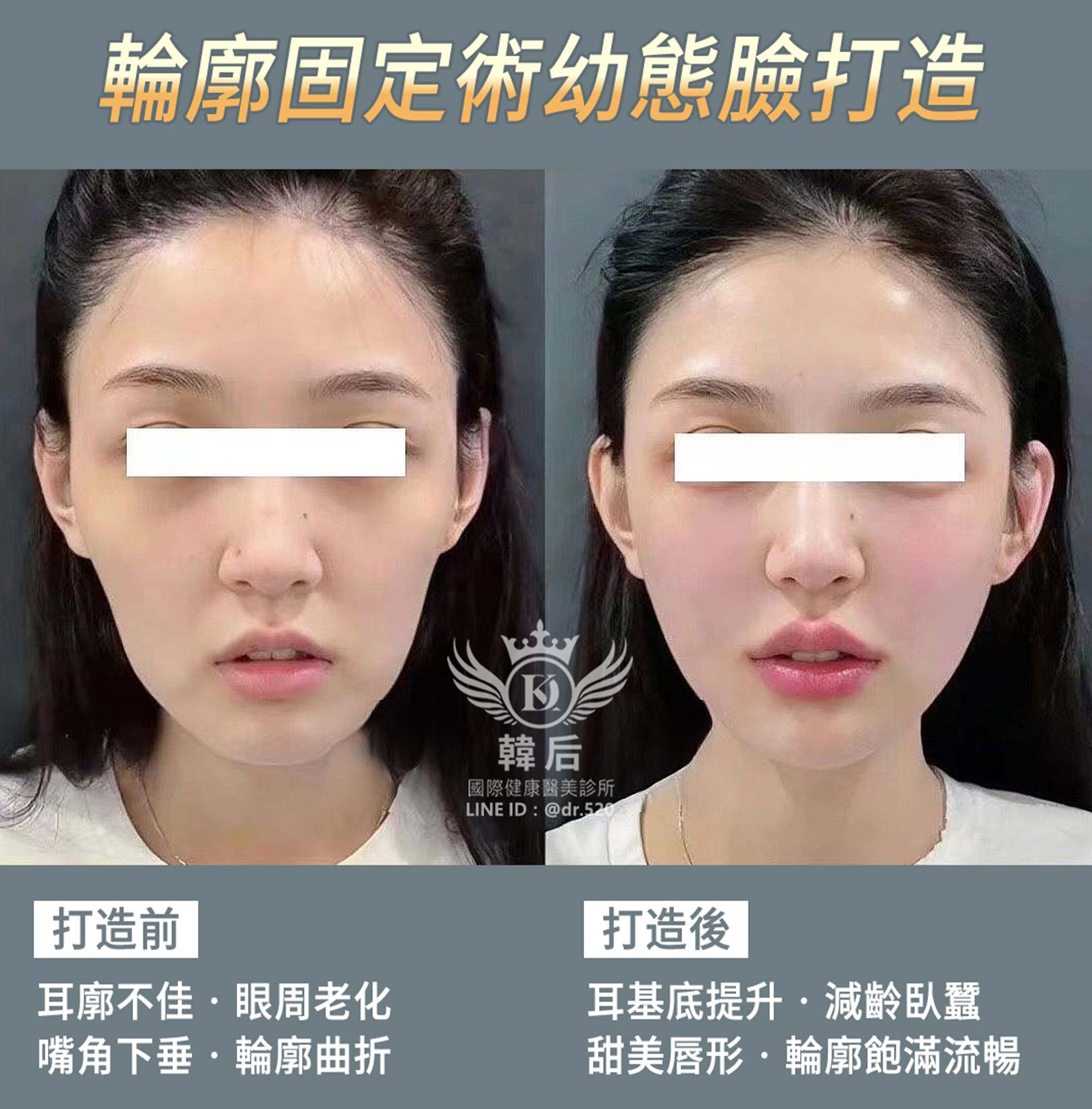 輪廓固定,幼態臉,全臉精雕,唇周,眼袋,淚溝,凹陷,蘋果肌,夫妻宮,木偶紋,皺紋,韓后醫美,改造前後,素人真實案例